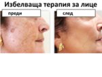 избелващ крем за лице, избелваща  http://foryoubg.com/product/izbelvashcha-terapiya-za-litse-piling-maska-krem-i-losionмаска